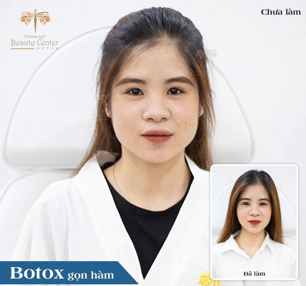 Tiêm Botox Thon Gọn Hàm Là Gì Giữ được Bao Lâu 2